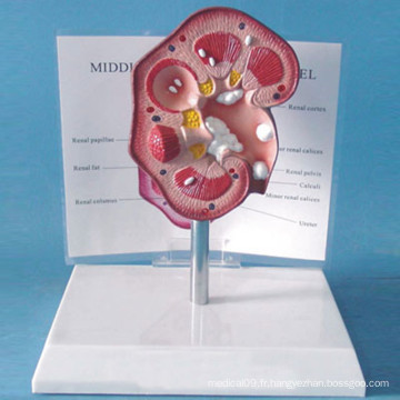 Modèle médical d&#39;anatomie des calculs rénaux humains (R110107)